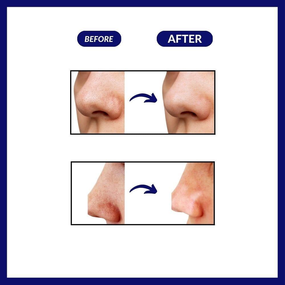 Blackhead Remover™ Deluxe - Vinhousse