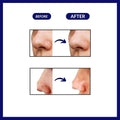 Blackhead Remover™ Deluxe - Vinhousse